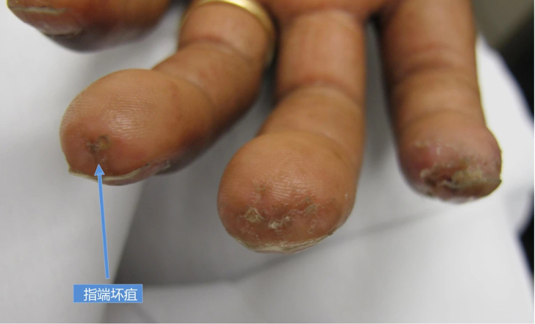 张医生解释,对于有雷诺现象的患者来说,指端发冷只是表象,小血管痉挛