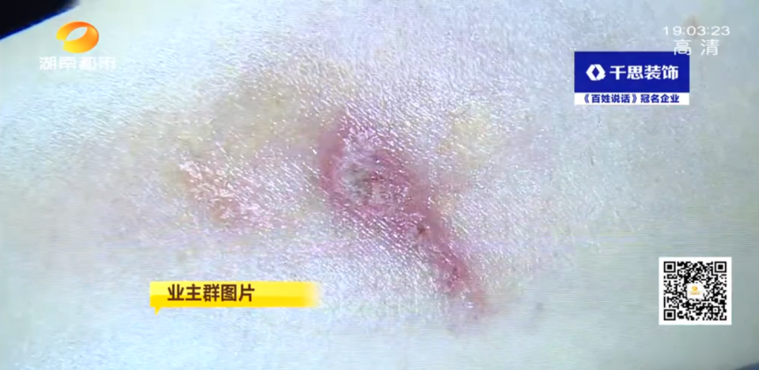 长沙一小区多名业主被"黑虫"毒伤,有医院7天接诊百余例!