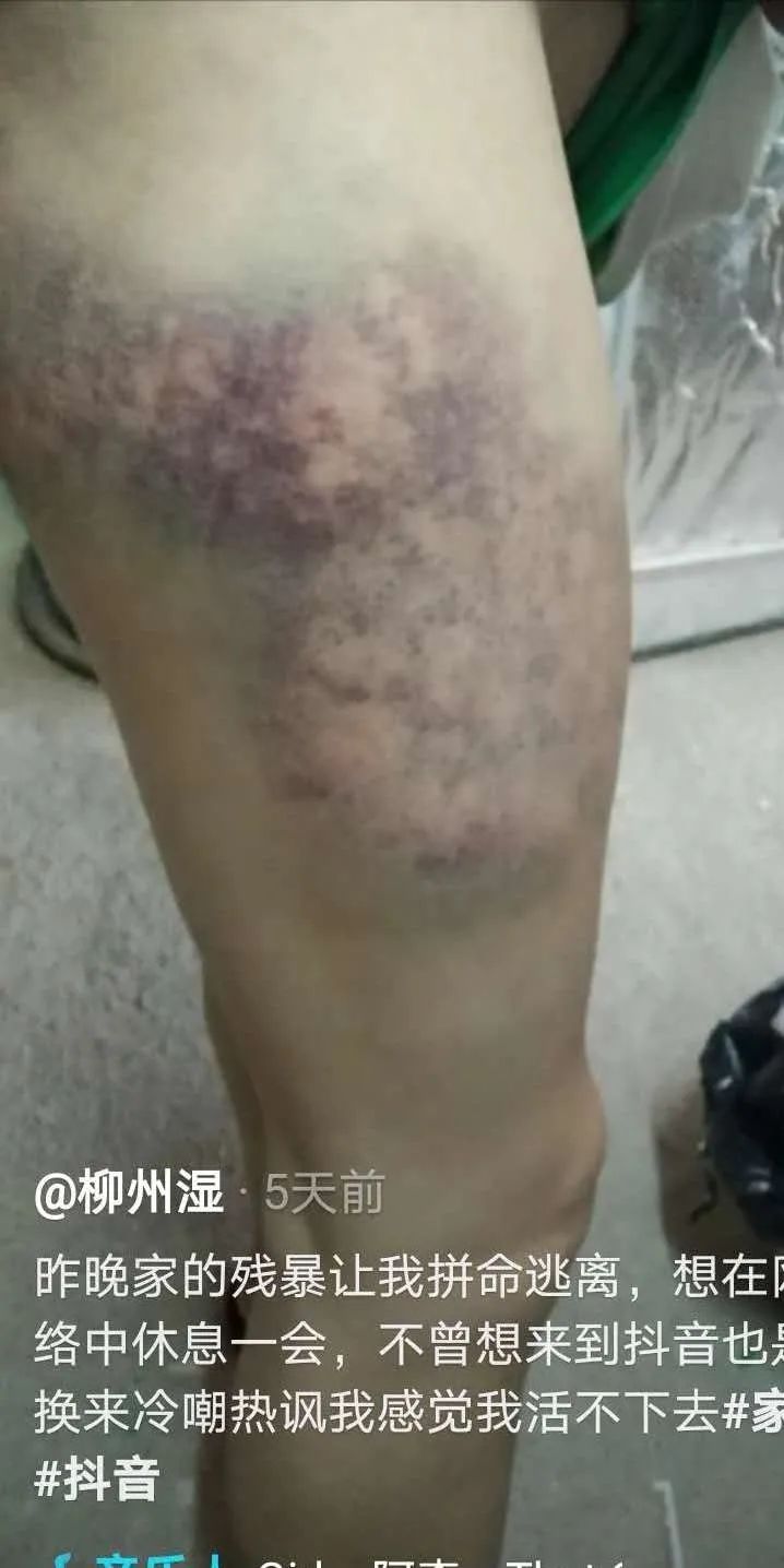 柳州一女子被家暴，拍抖音求救