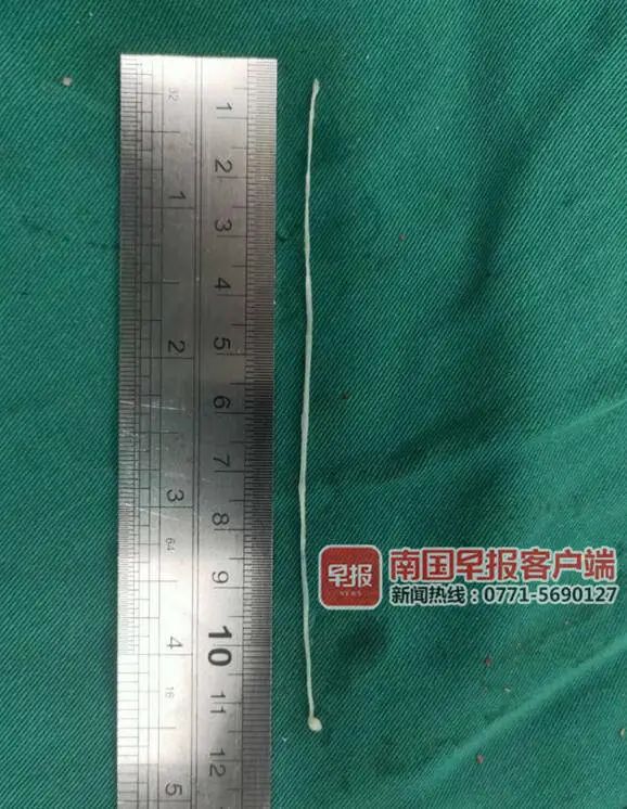 男子脑袋长了条11厘米的虫