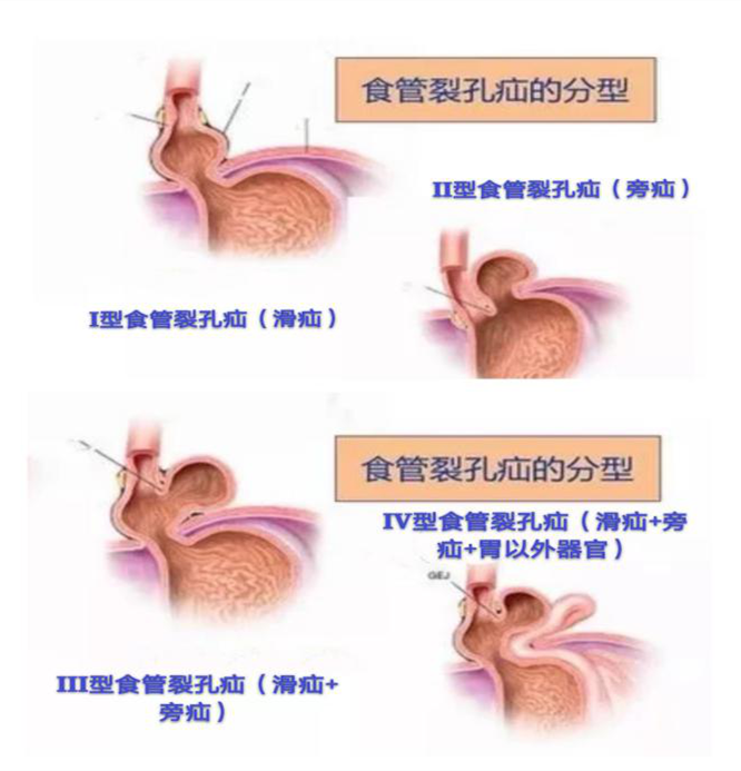 1岁幼儿频繁呕吐，柳州医院一检查，胃不见了北地之卵